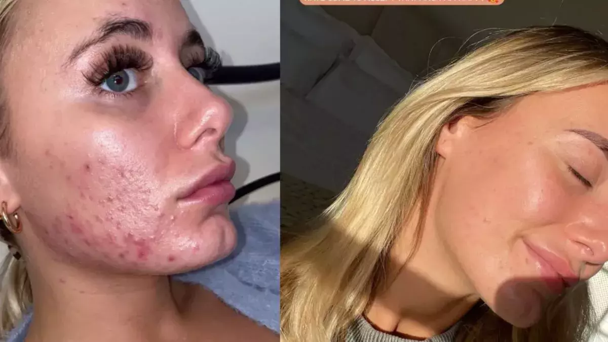 Love Island: Millie shares her acne battle transformation in a new YouTube video