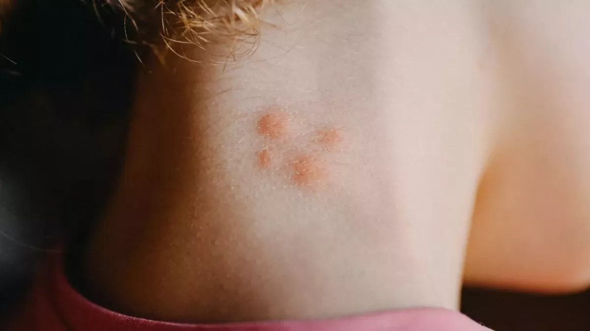 Shocking death of 19-year-old student following spider bite  