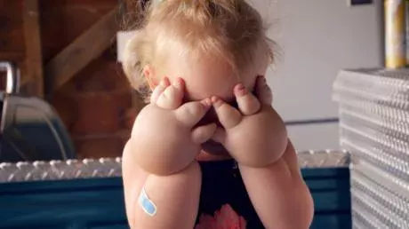 A 2-year-old girl with fat hands got liposuction!
