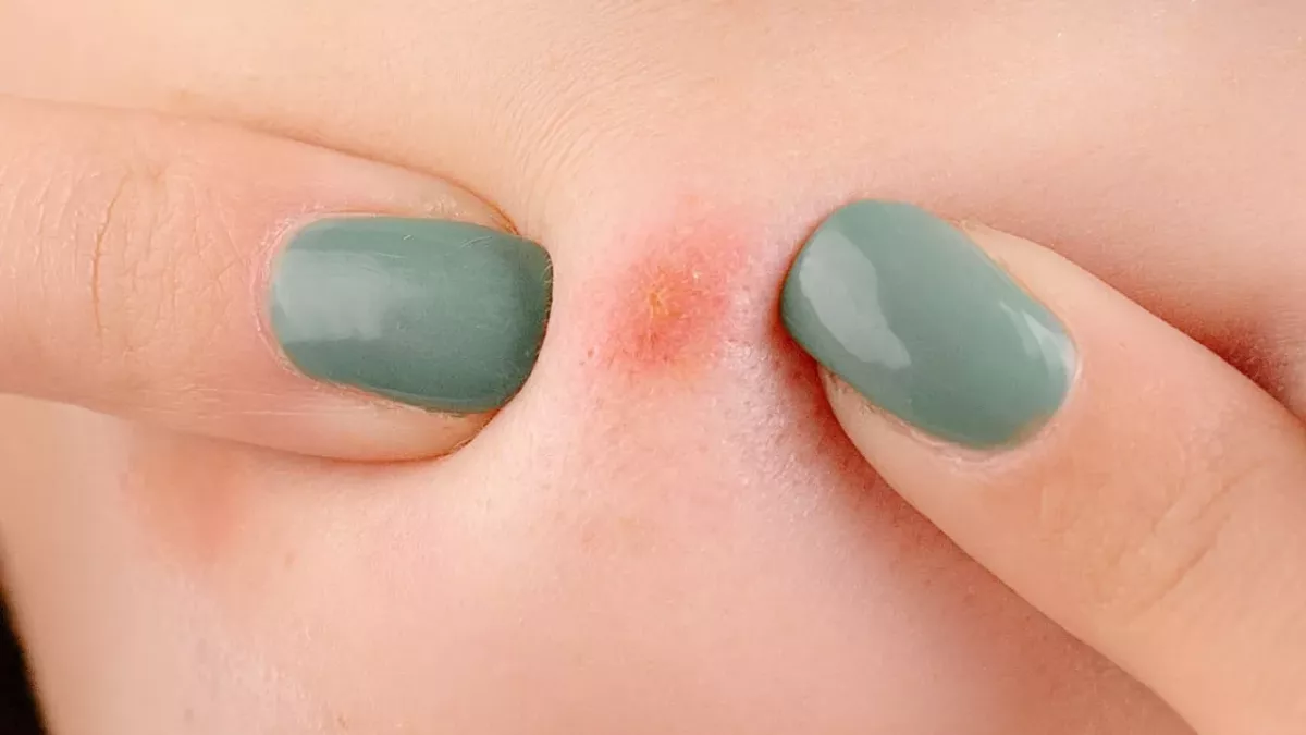 After 20 years, this woman finally gets rid of giant blackhead that was ruining her life