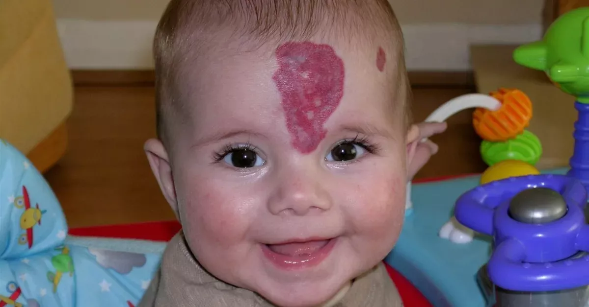 Birthmark