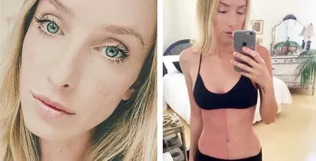 birthmark