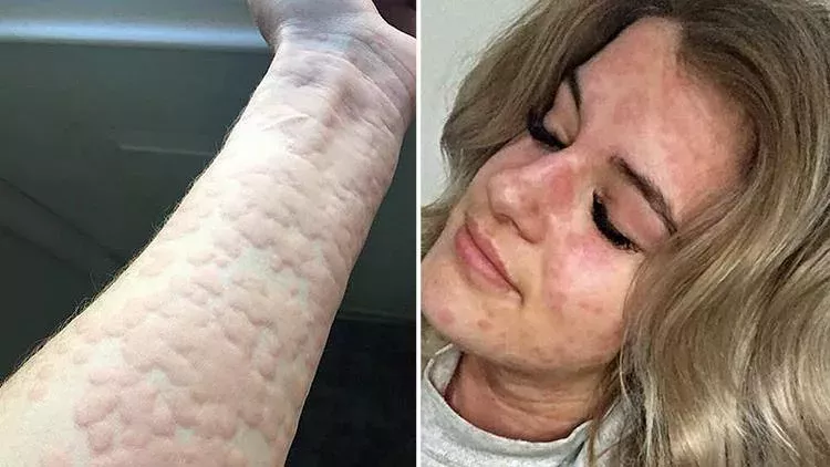 Canada cold allergy