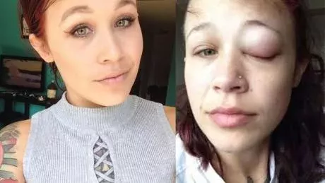 In Canada, a woman got the inside of her eyelid tattoed, and ended up with a serious infection.