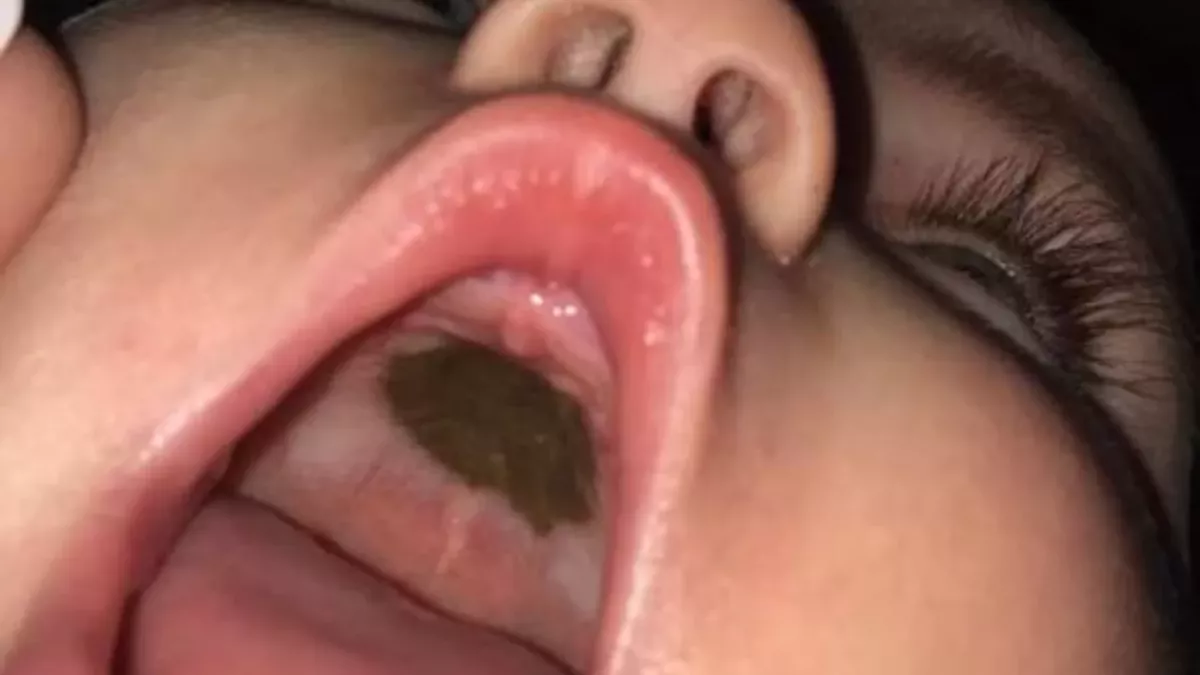 A Dark Spot in Her Baby's Mouth Made for an Embarrassing Doctor's Visit