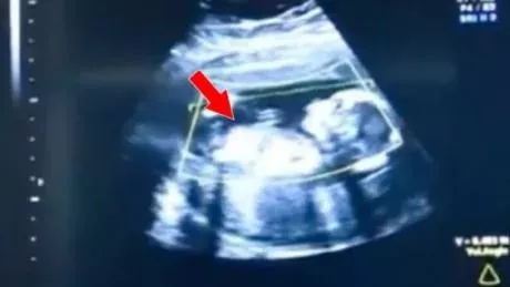 Ectopic pregnancies are rare but potentially fatal.