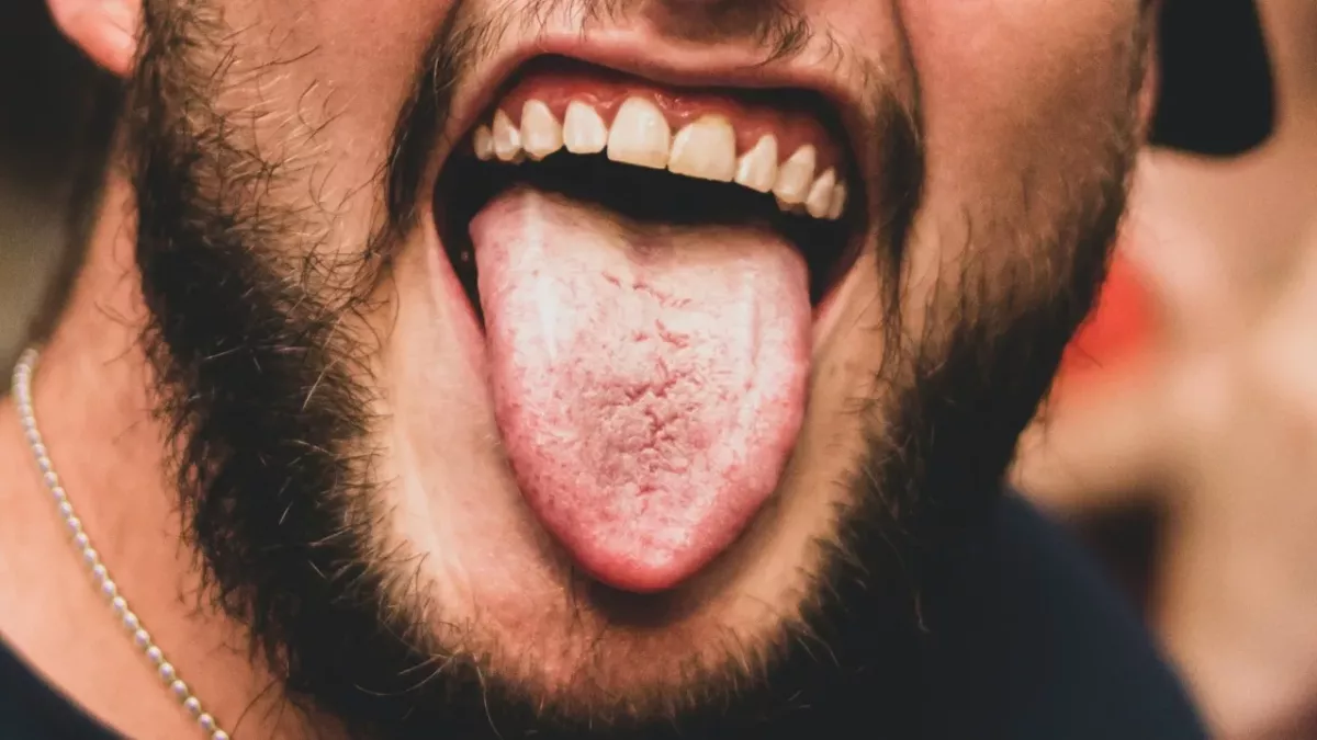 Hairy tongue: This man was diagnosed with this rare condition after his tongue turned green and hairy