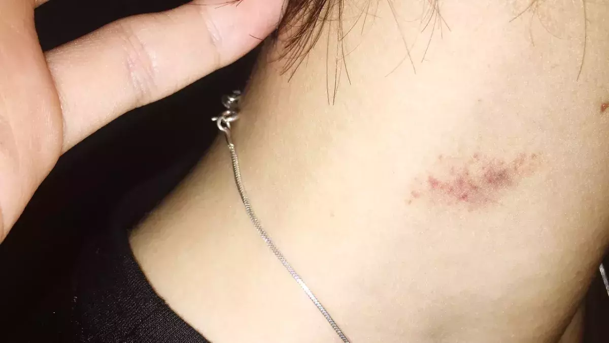 Love bite can cause stroke