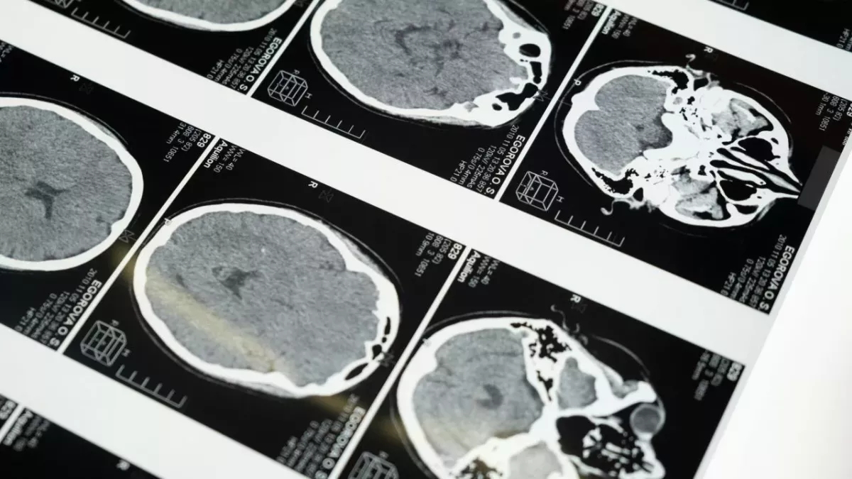man chopsticks lodged in the brain for 5 months