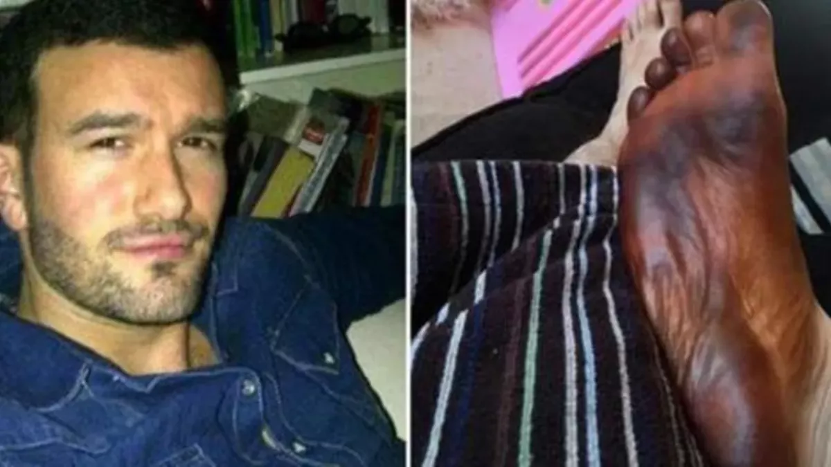 This Man Was Left Terrified After Discovering His Foot Was Completely Black