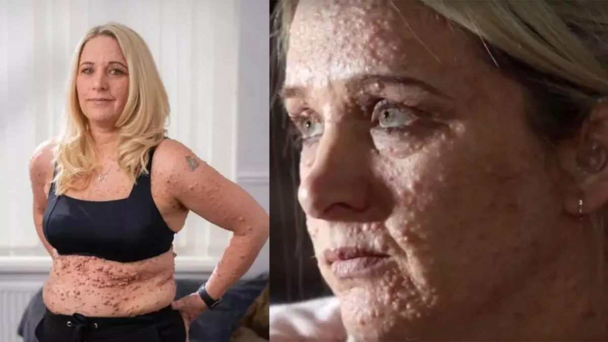 Skin disease