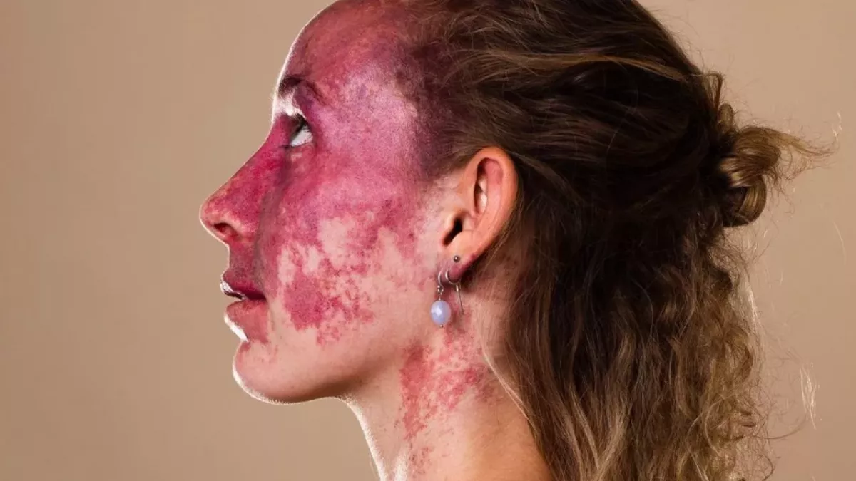 They Made Fun of Her Birthmark, but She's Turned It Into Something Inspiring