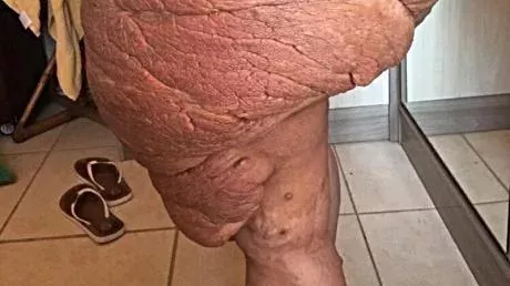 Tumours