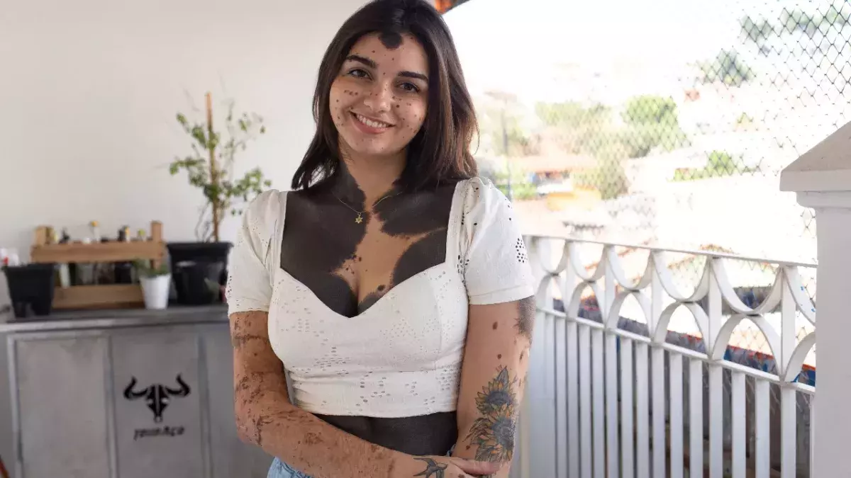 Women with full body birthmarks embraces body positivity