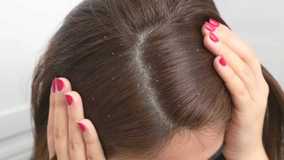 Dandruff