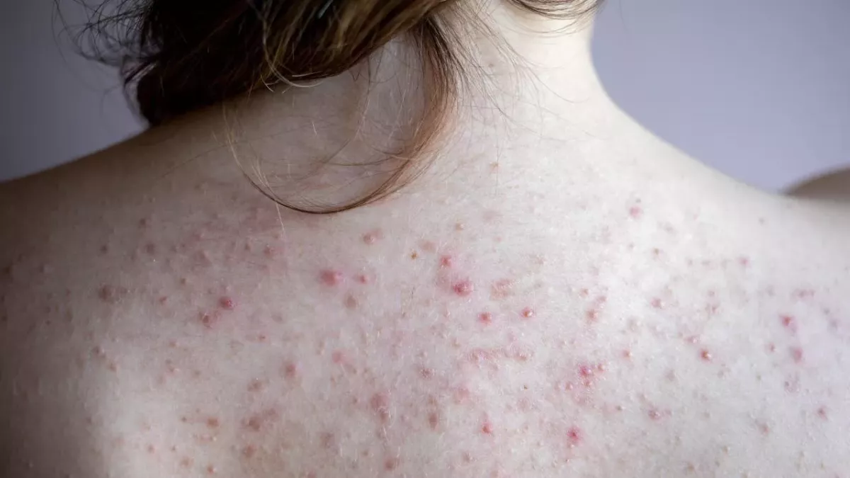 Everything You Need To Know About Back Acne 