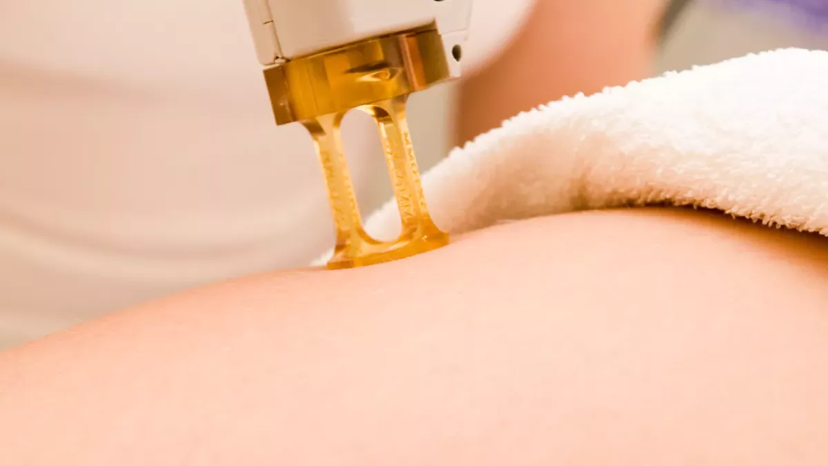This is everything you need to know before your laser hair removal appointment