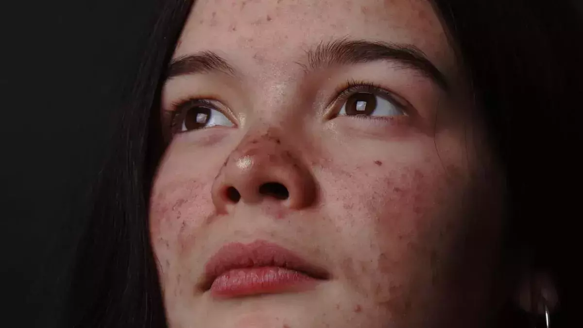 A Foolproof Guide To Using Spironolactone For Acne