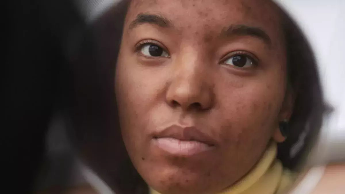 How To Eliminate Post-Inflammatory Hyperpigmentation