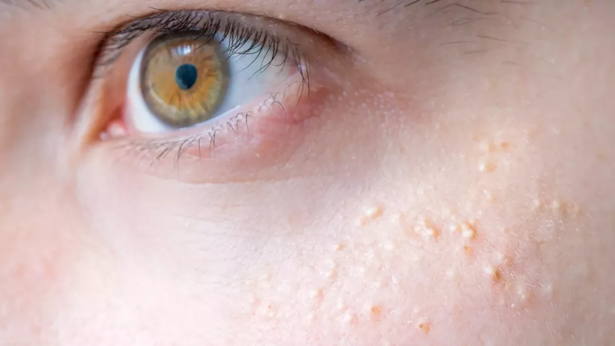 milia milk spots