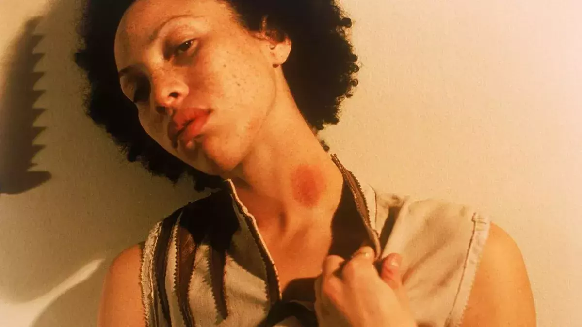 Six Ways To Get Rid of a Hickey That Actually Work — And Two That Don't