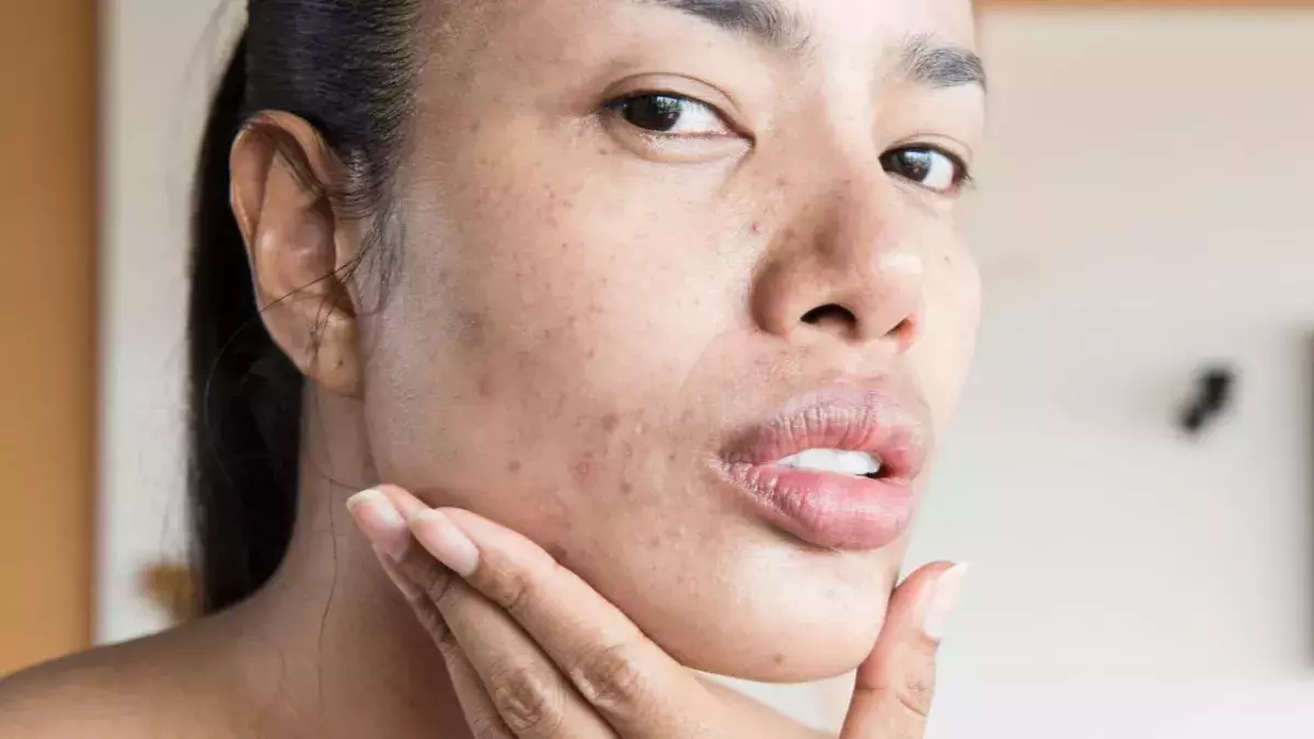 Understanding What Triggers Hormonal Acne and How To Treat It