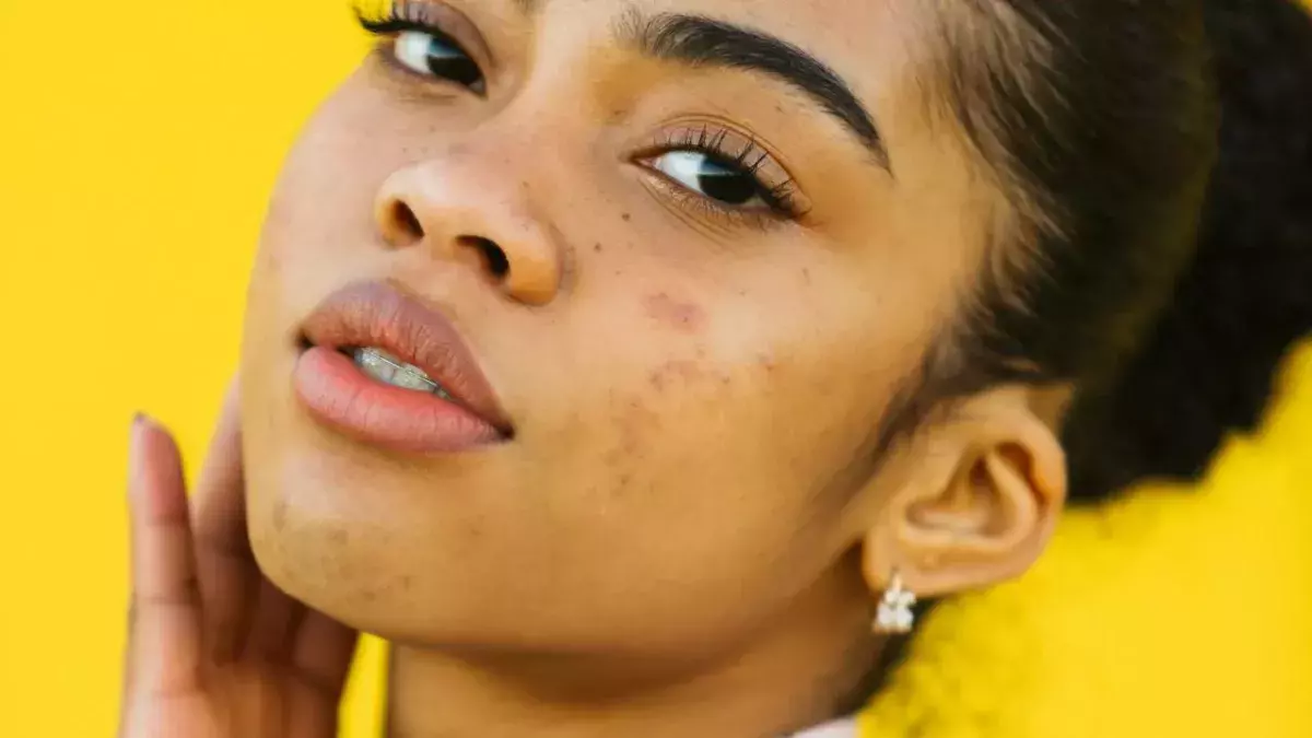 Understanding Your Acne Scars and How To Treat Them