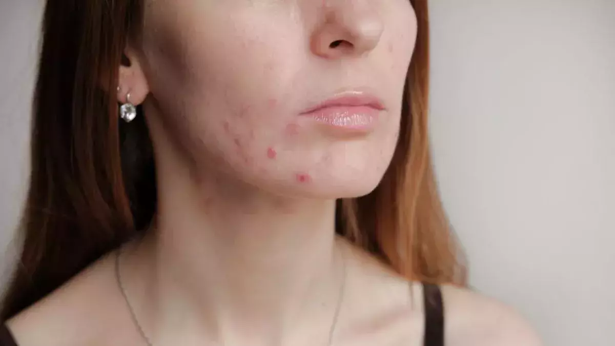 What Is Post-Inflammatory Erythema and How To Treat It