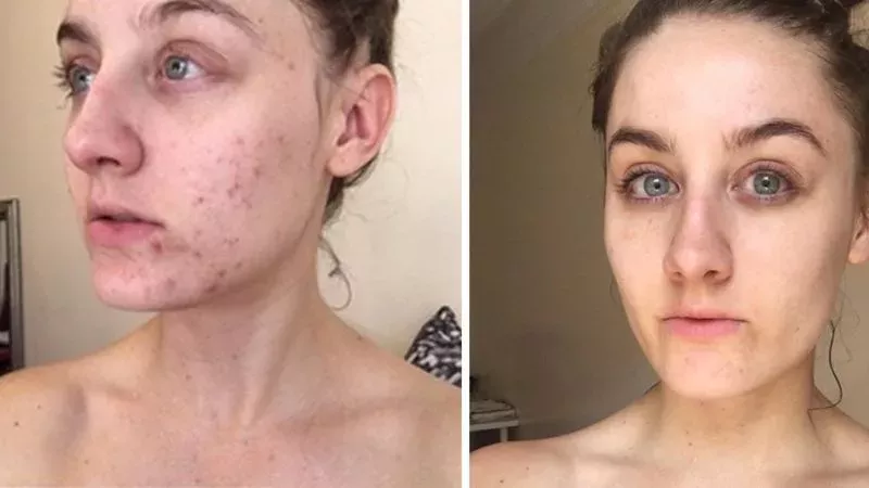 This Woman Stopped Washing Her Face For Six Months And Cured Her Acne