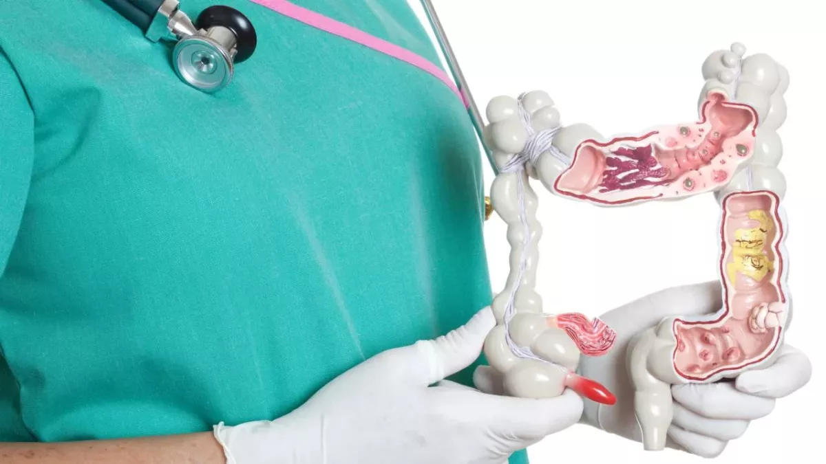 Eating ultra-processed foods like chips and soda can cause bowel cancer, study suggests