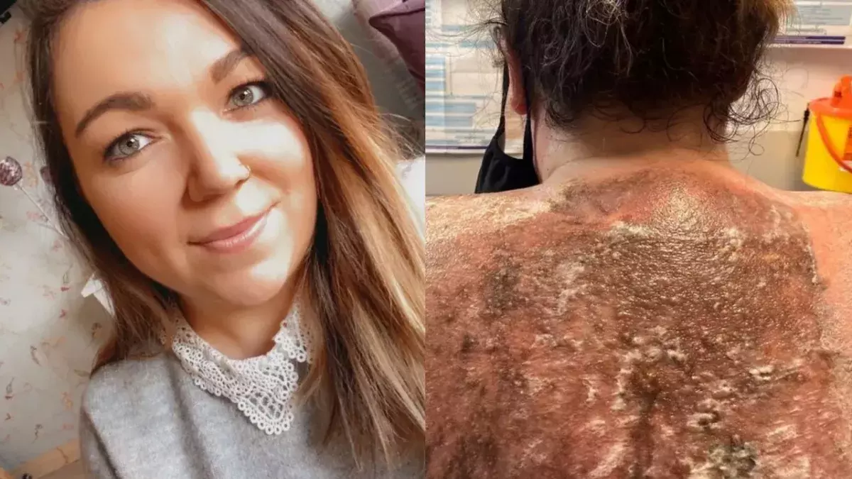 Mum gets sunburnt during UK heatwave