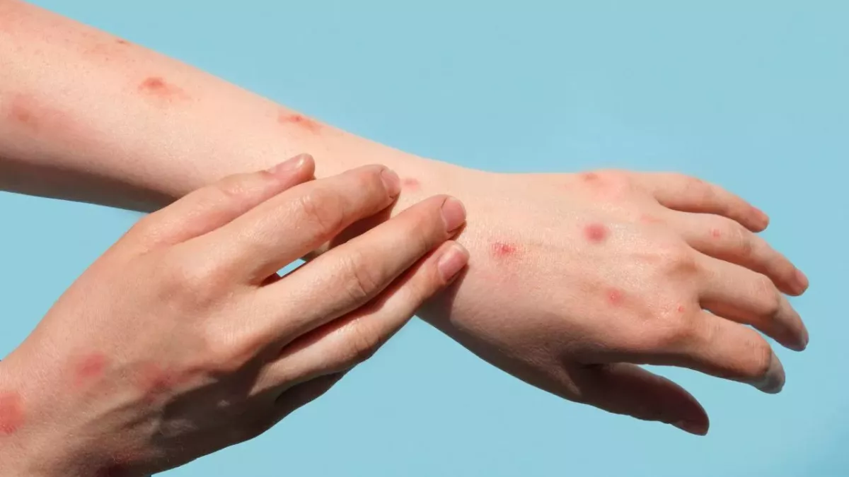 US infected with 1/3 of monkeypox cases worldwide, but the virus isn’t the only thing that’s spreading 