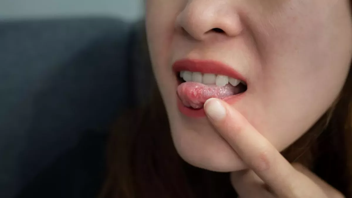 canker sore tongue cancer