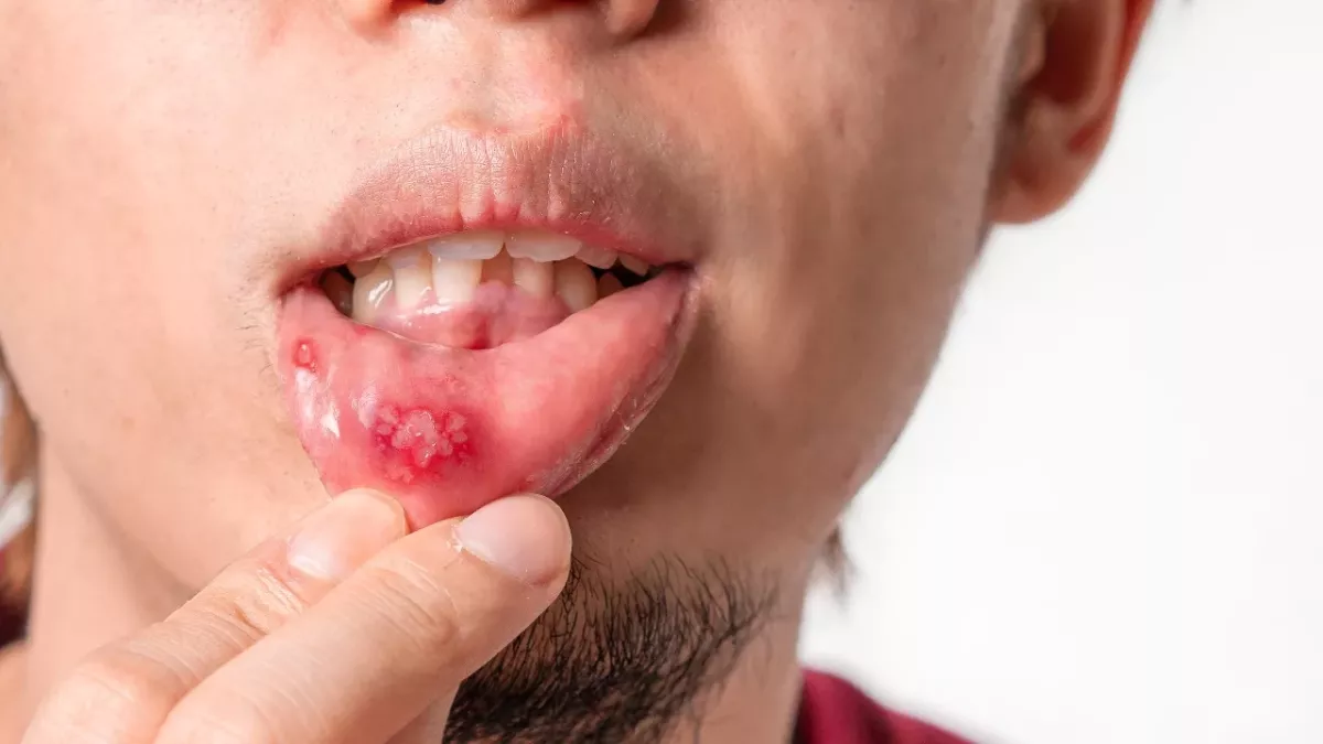 Cold sore