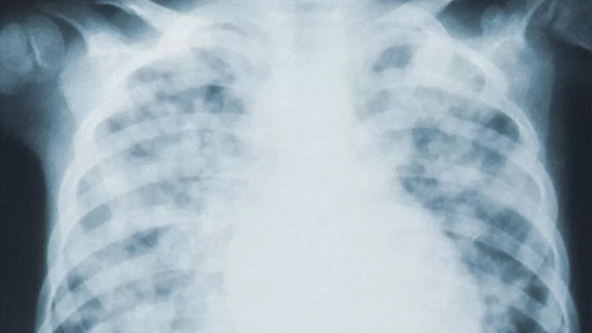 COVID pneumonia