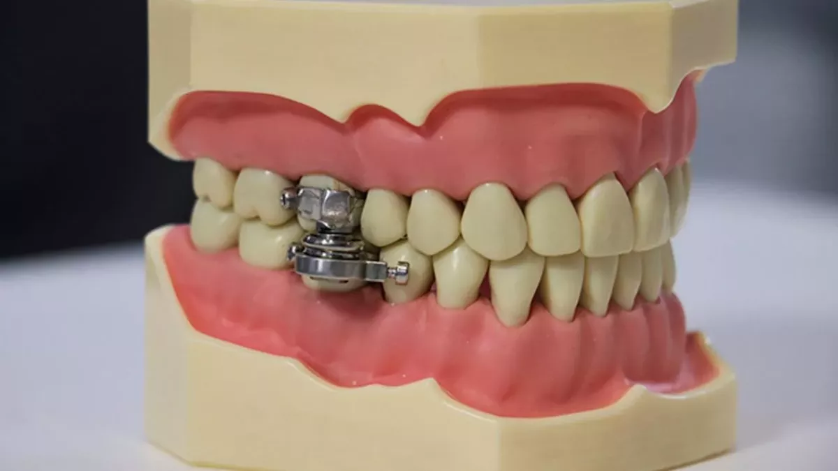 The device only allows the mouth to open by 2mm