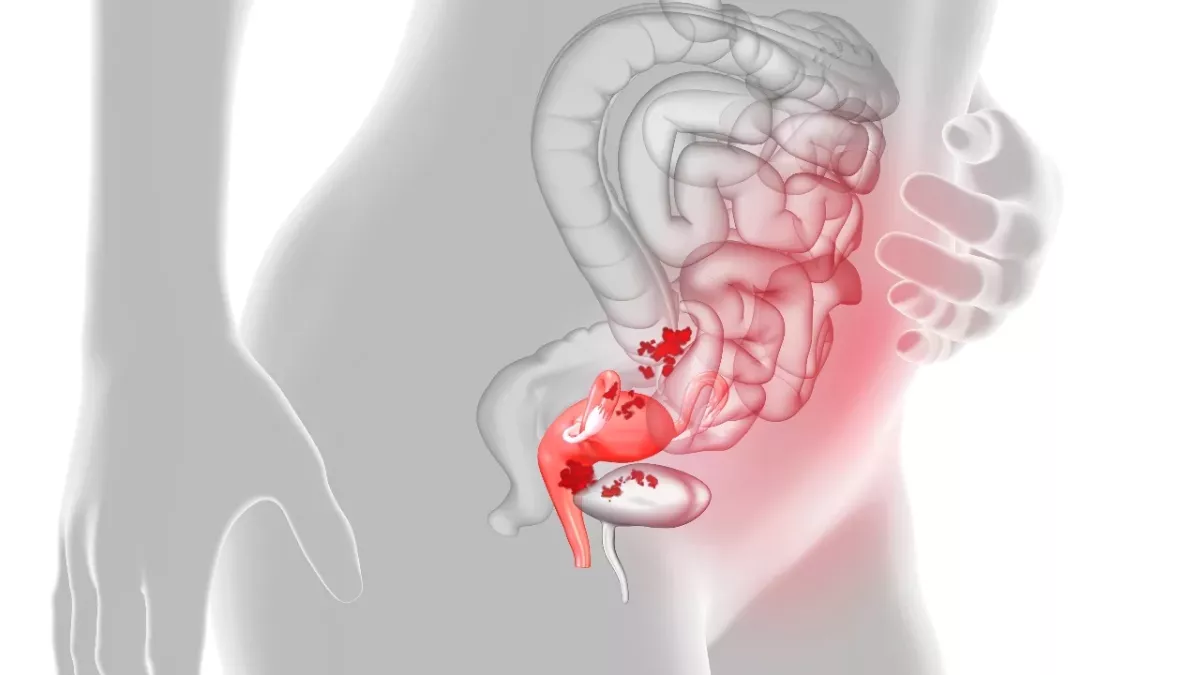 Endometriosis