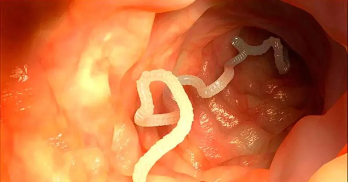 He Pulled A 10-Meter Tapeworm From His Backside
