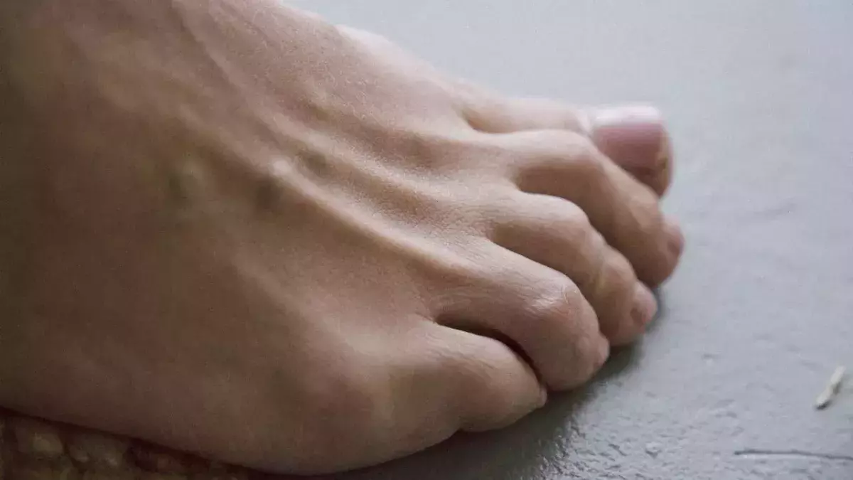 High cholesterol toenails health condition