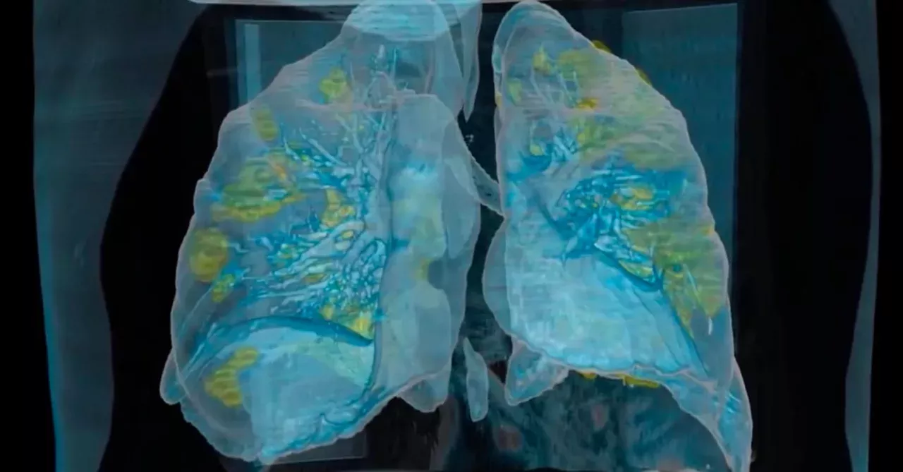 How the coronavirus affects the lungs can be seen for the first time in this video