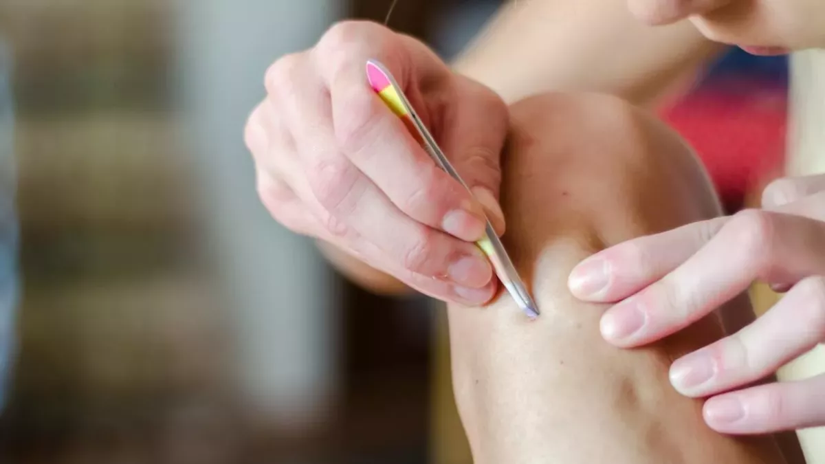 Ingrown hairs: The gross reason you should never pluck them