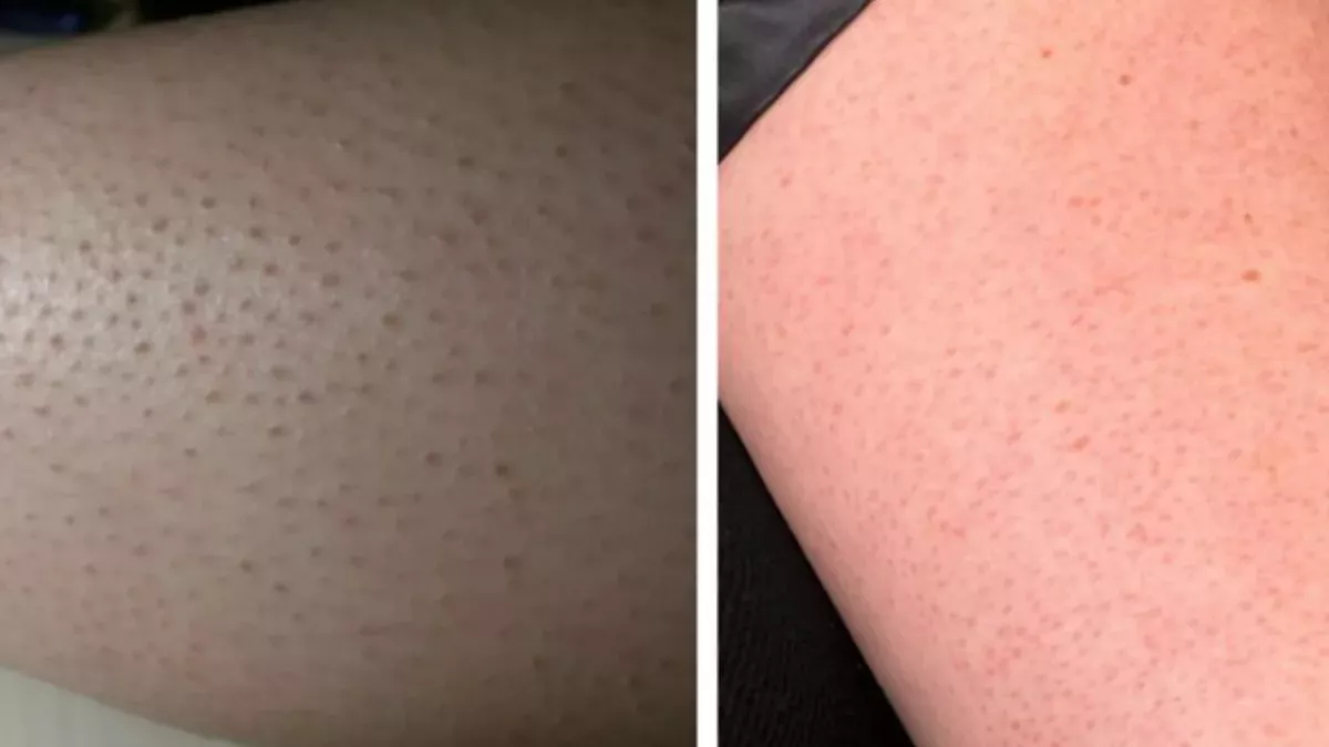 Keratosis pilaris