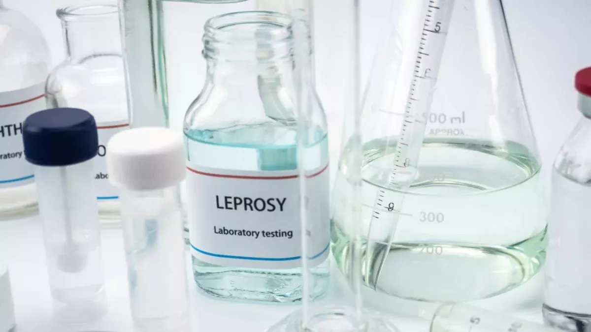Leprosy cases on the rise: Here's what you should know about this infectious illness