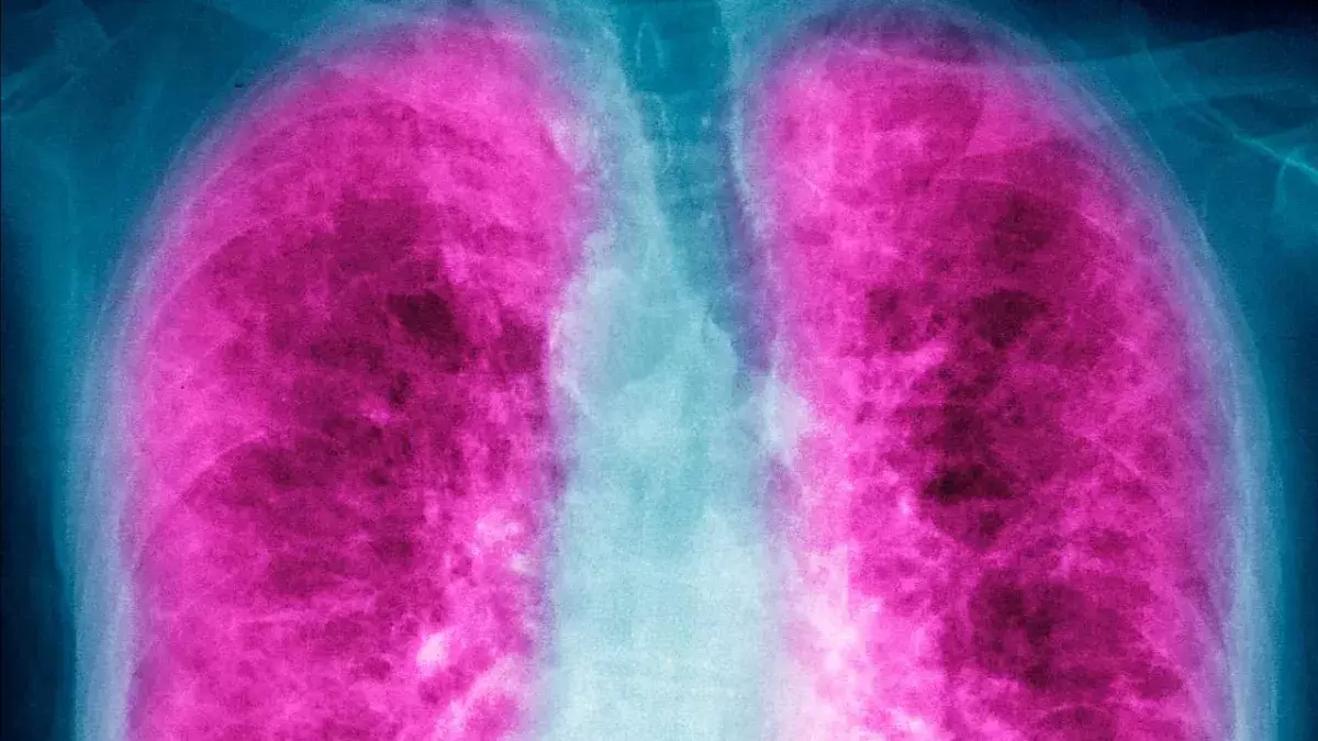Lung cancer warning signs