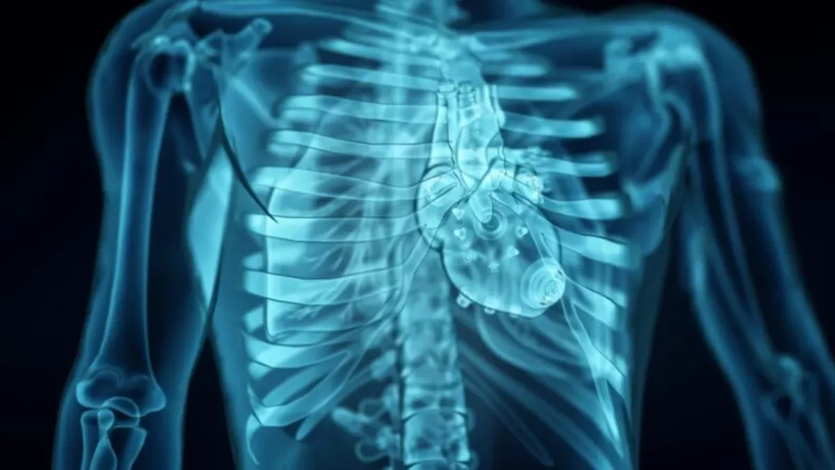 LVAD no heart beat Left Ventricular Assist Device
