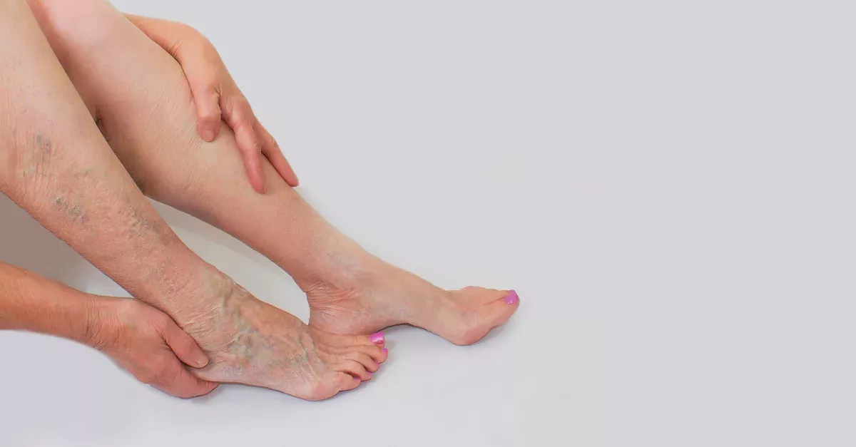 This Natural Remedy Will Finally Help You Get Rid Of Your Varicose Veins
