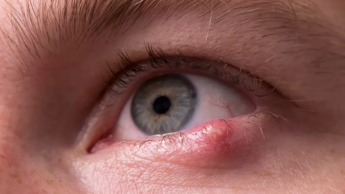 Stye