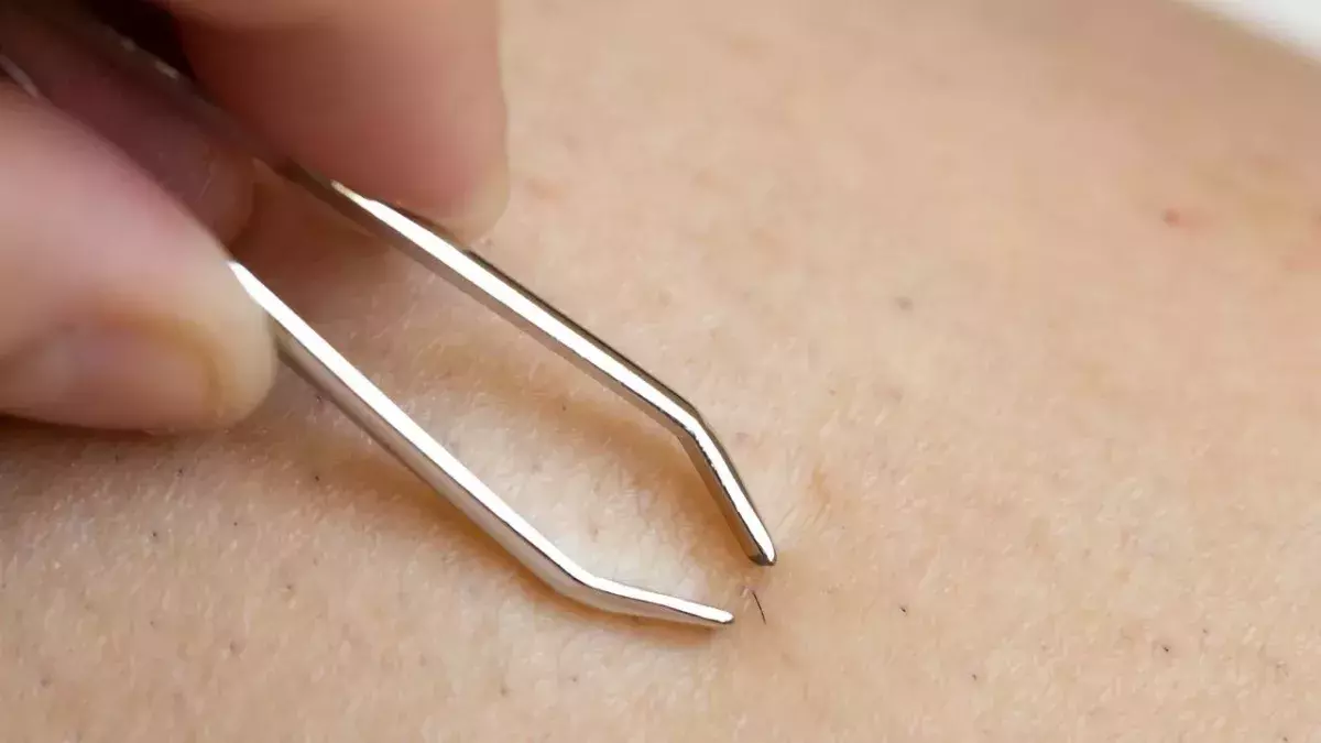 These are the best home remedies for ingrown hairs 