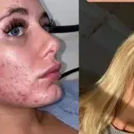 Love Island: Millie shares her acne battle transformation in a new YouTube video
