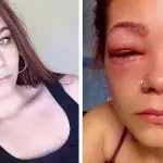 Allergic to dye